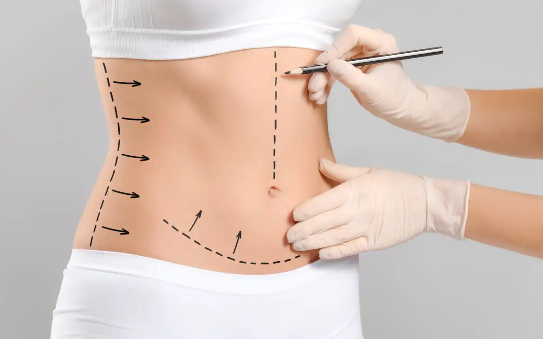 Post-Weight Loss Surgery